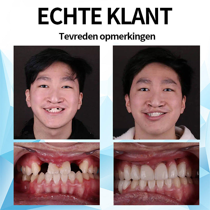 Mresio™ Silicone Gevoerde Prothese Kit (👩‍🔬 aanbevolen door tandarts)