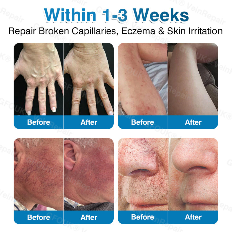🇨🇦🏆🏃‍♀️GFOUK® VeinRepair Microneedle Patch Roll⚡Instant Relief, Long-Term Results