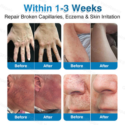 🇨🇦🏆🏃‍♀️GFOUK® VeinRepair Microneedle Patch Roll⚡Instant Relief, Long-Term Results