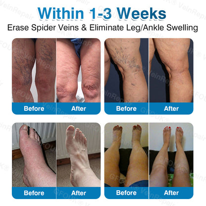 🇨🇦🏆🏃‍♀️GFOUK® VeinRepair Microneedle Patch Roll⚡Instant Relief, Long-Term Results
