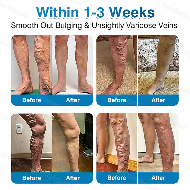 🇨🇦🏆🏃‍♀️GFOUK® VeinRepair Microneedle Patch Roll⚡Instant Relief, Long-Term Results